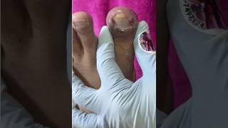 Ep_8467 Ingrown toenail removal 👣 พี่ต้องตัดข้างเล็บ..เล็บมันแทงอยู่ในเนื้อ 😄 (clip from Thailand)