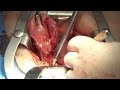 Total Abdominal Hysterectomy Surgery - THUNDERBEAT - Olympus Surgical - Dr. Francois Blaudeau