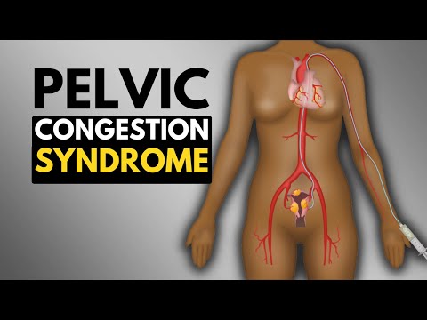 Lymphedema Causes Signs and Symptoms Diagnosis and Treatment