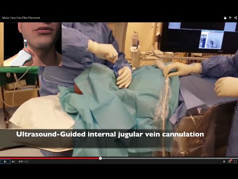 Inferior Vena Cava Filter Placement