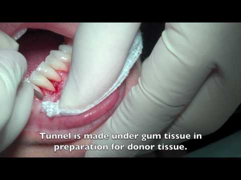 Gingival Graft 