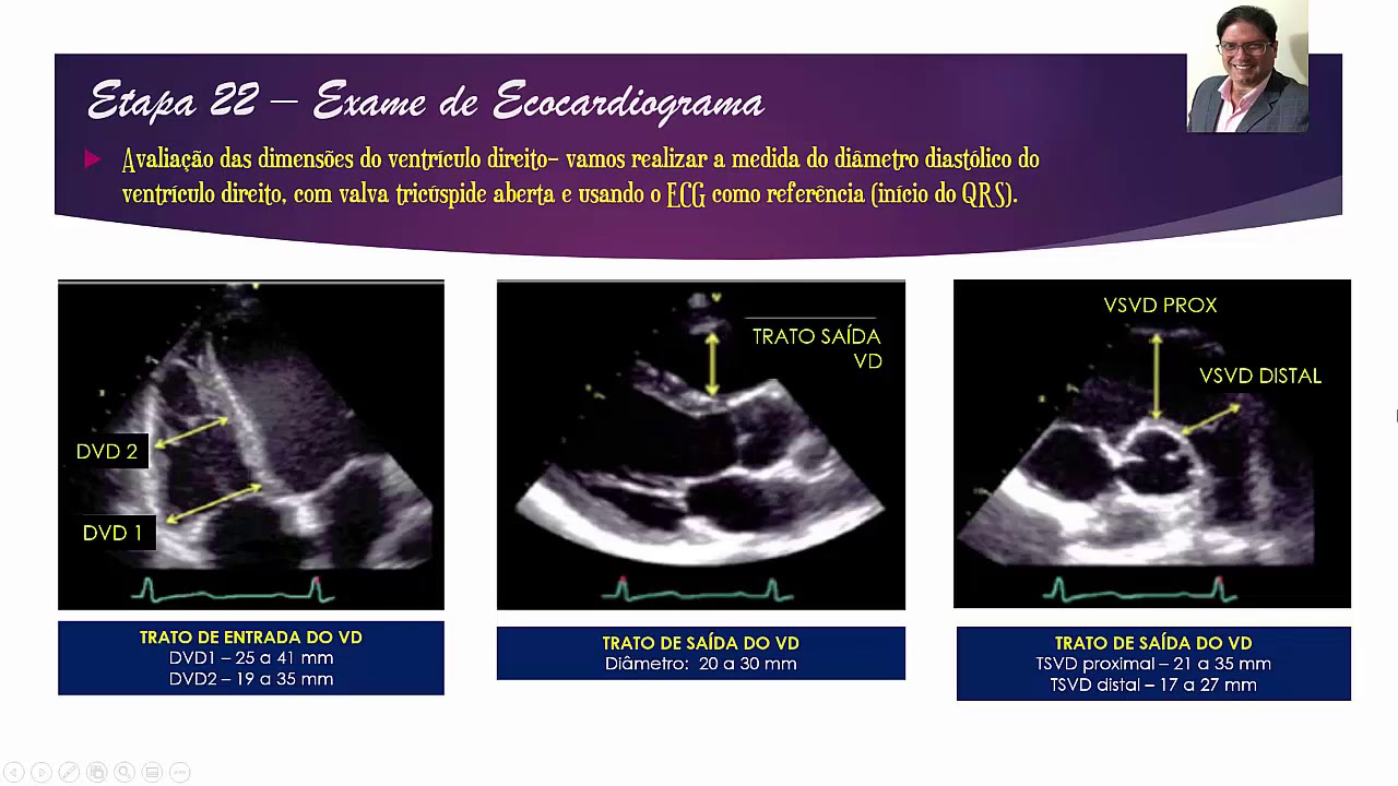 EPISÓDIO 22   ESTUDO DO VENTRÍCULO DIREITO