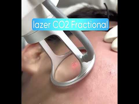 Acne Scar Treatment in Poipet