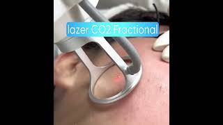 CO2 Laser Scar Treatment