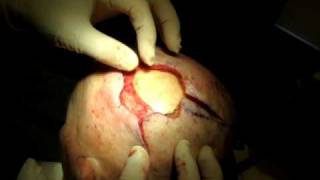 preview picture of video 'Surgery Video Vignettes / Scalp Squamous Cell Carcinoma'