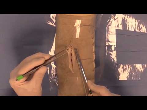 Subcutaneous Suture Pattern