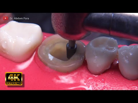 Root Canal Treatment Step by Step