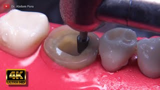 Download lagu Root Canal Treatment Step by Step mp3 Download lagu Root Canal Treatment Step by Step mp3