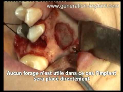 comment traiter fistule dentaire