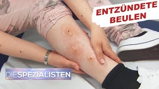 Beulen an den Beinen: Parasitenbefall? | Auf Streife - Die Spezialisten | SAT.1 TV