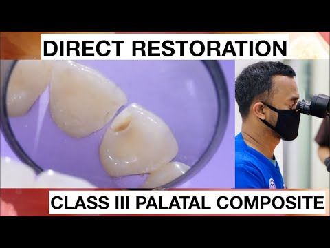 Step By Step - Palatal Class III Composite Restoration