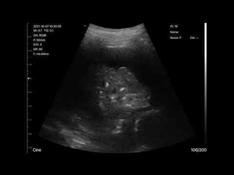 BEDSIDE ULTRASOUND WITH CERBERO ATL Wireless Probe - pulmonary effusion with atelectasis