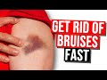 How to Get Rid of Bruises - 7 Pro Tips and Natural Remedies