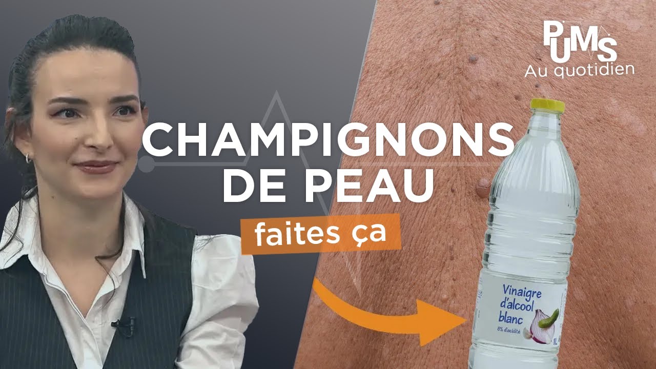 Du VINAIGRE contre les CHAMPIGNONS de la peau : efficace ?