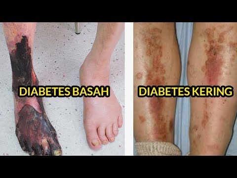 Anak diet untuk menurunkan berat badan dalam 13 tahun Menu untuk 1200 kalori per hari dan menurunkan berat badan