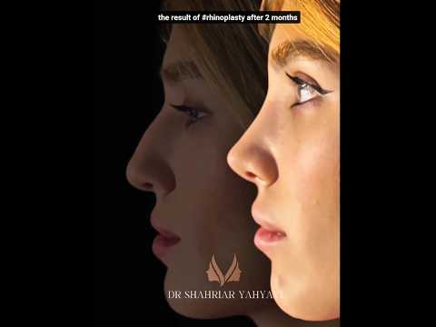the result of #rhinoplasty closed method by Dr Shahriar yahyavi