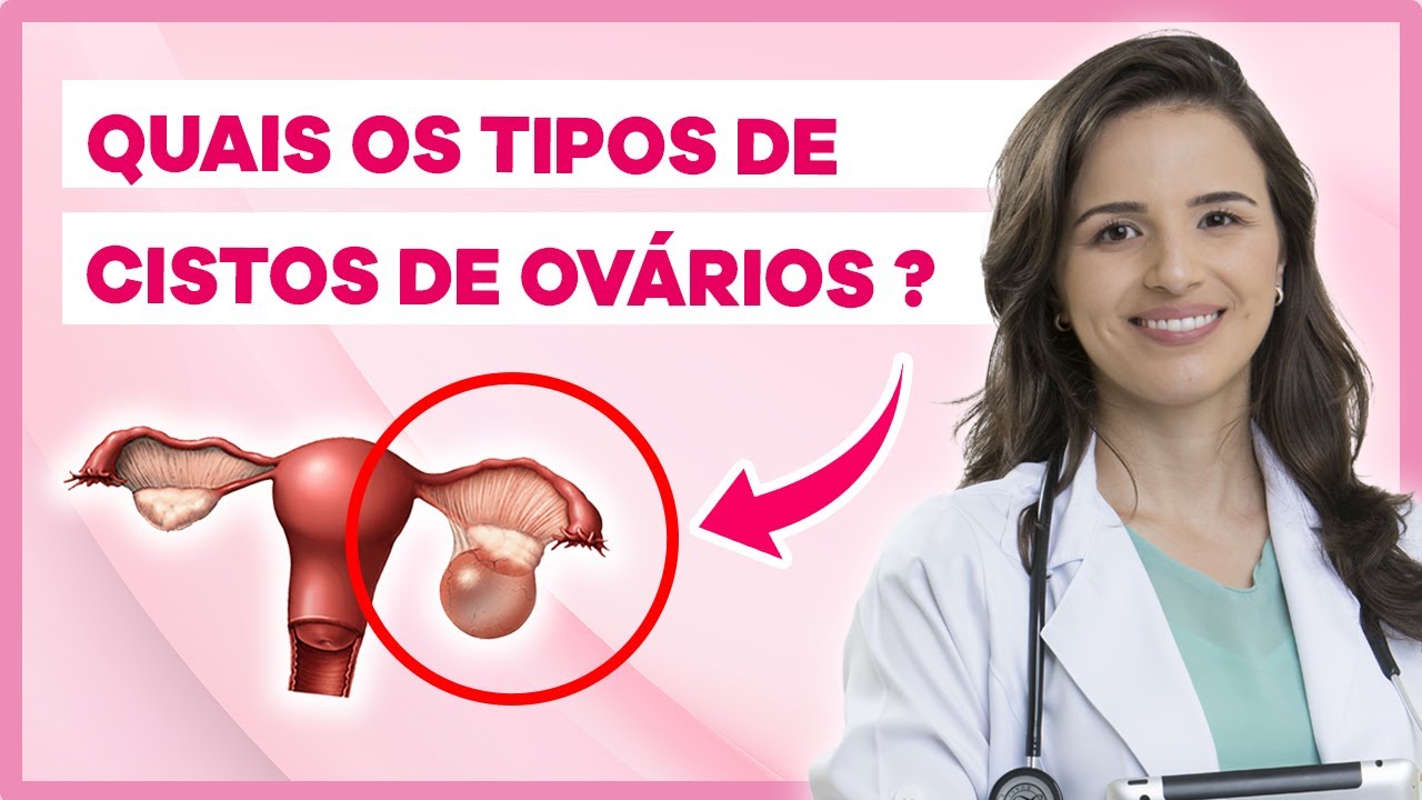 Tipos de Cisto no Ovário e Quando devemos fazer cirurgia
