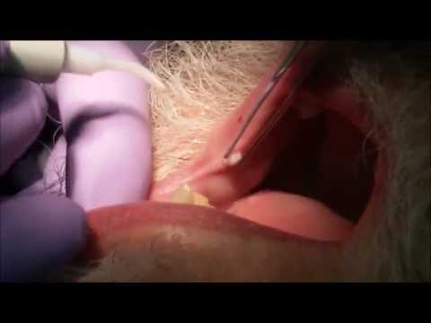 Hirsutoid papilloma férfiak kezelésében