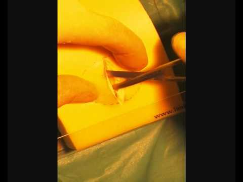 Lipoma Removal Technique