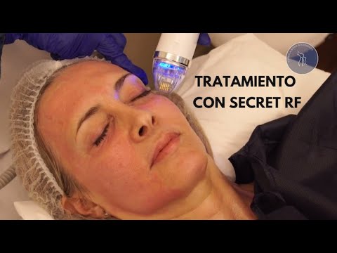 Tratamiento con Secret RF