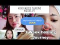 HIKO NOSE THREAD LIFT w/ FULL ALARTOX | May lumawit na thread | 1 week healing journey