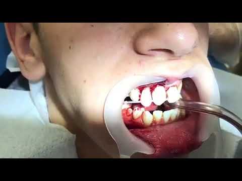 Dental Trauma - Fixing Tooth Intrusion & Avulsion