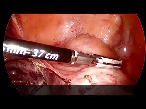 Uterine Vessel Ligation & Transection