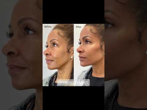 Instant, Non-Surgical Facial Contouring