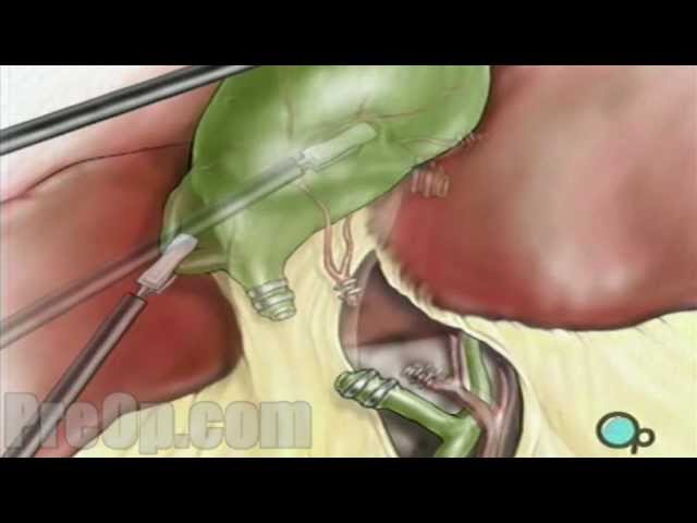 Video Pronunciation of laparoscopic in English