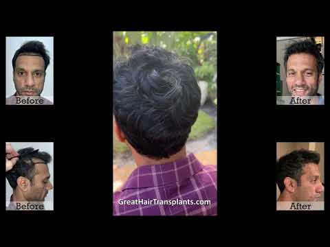 Srini Hair Transplant Testimonial