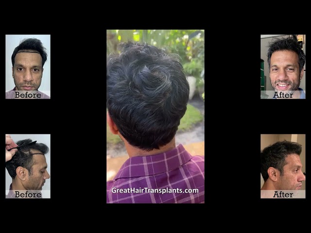 Patient Hair Transplant Video