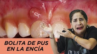 Bolita de pus en la encía