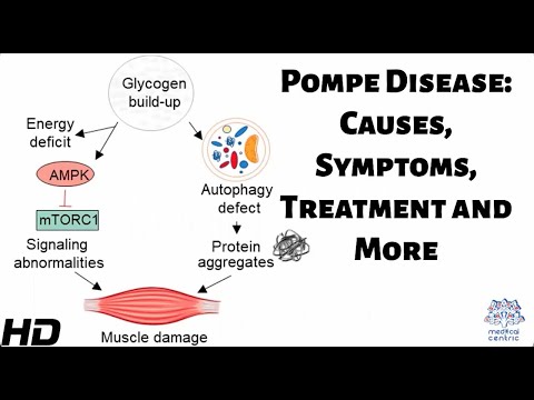 Alport Syndrome Causes Signs and Symptoms Diagnosis and Treatment