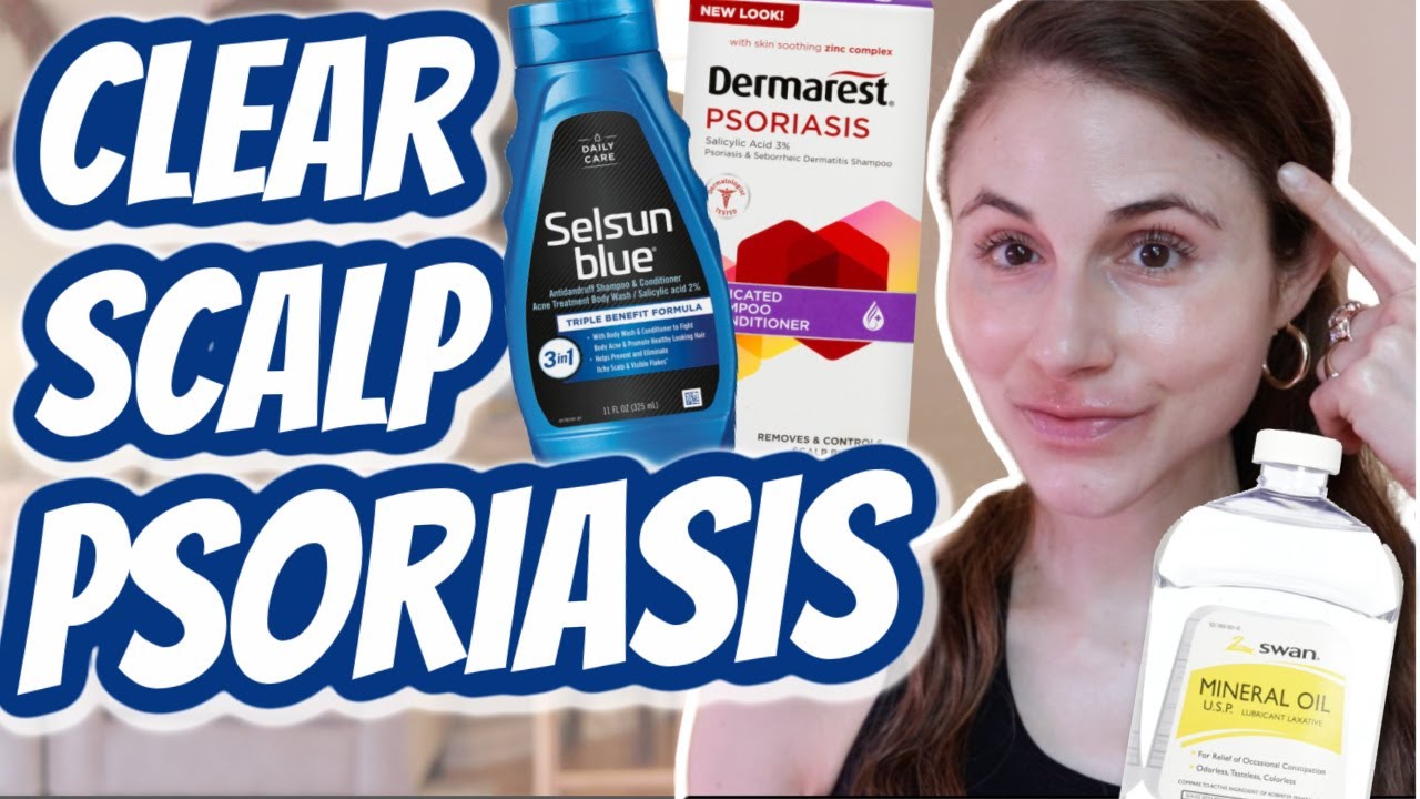 How to CLEAR SCALP PSORIASIS| Dr Dray