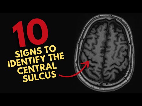 How to find the central sulcus on MRI