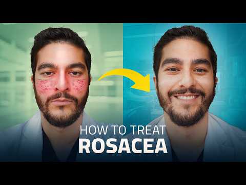 Struggling with Rosacea? Here Are the Best Treatments for 2025