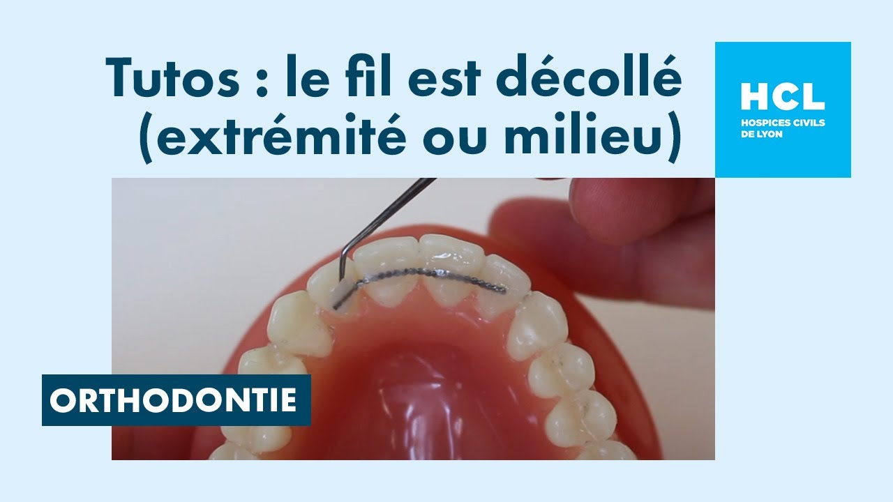 Le fil de contention décollé