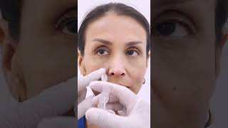 AUMENTO DE PÓMULOS CON ÁCIDO HIALURÓNICO - DR. FRANK ZEGARRA