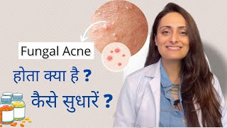 Fungal acne kya hota hai | kaise control kare | Tvacha ke doctor | Dr. Aanchal Panth
