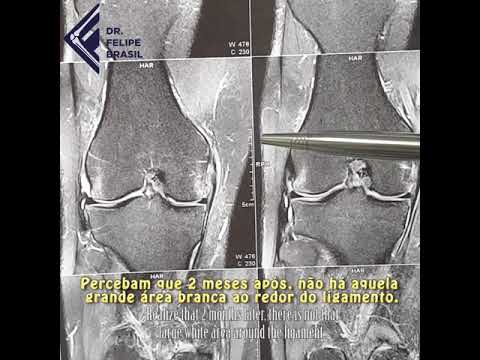 Osteoporoză și durere în articulația genunchiului