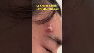 Infected face cyst #shorts #skincare #blackheads Dr Khaled Sadek