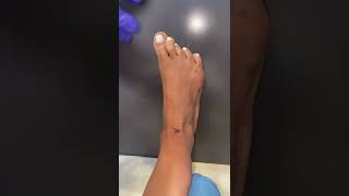 Crooked Toes Get A Major Transformation