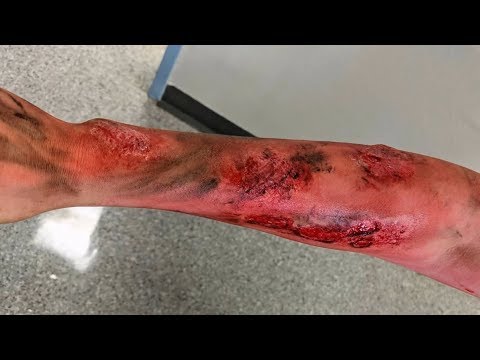 Realistische Unfalldarstellung Anleitung - Brandwunden