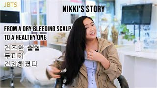 Bleeding, Itchy Scalp, Dandruff, Hair Loss - Nikki&#39;s True Story (JBTS)