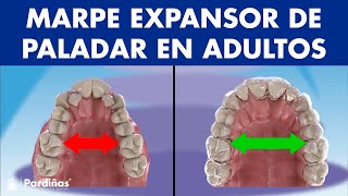 MARPE EXPANSOR de PALADAR - Así funciona el disyuntor de ortodoncia en adultos ©