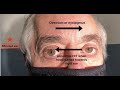 What Ear Does The Nystagmus In Vestibular Neuritis Beat Towards