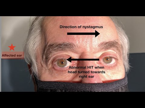What ear does the nystagmus in vestibular neuritis beat towards?