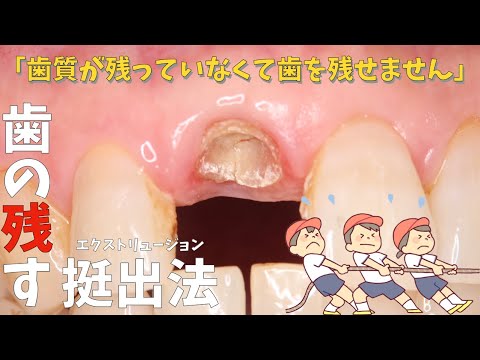 生命歯学科 【歯を残す最後の手段】残す歯がない！？歯肉の中の歯質を矯正によって挺出させるエクストリュージョンとは