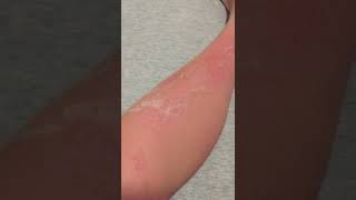 Skin Peeling from Sunburn #asmr