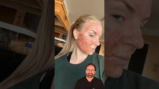 Next Day After CO2 Laser Surgeon Reacts